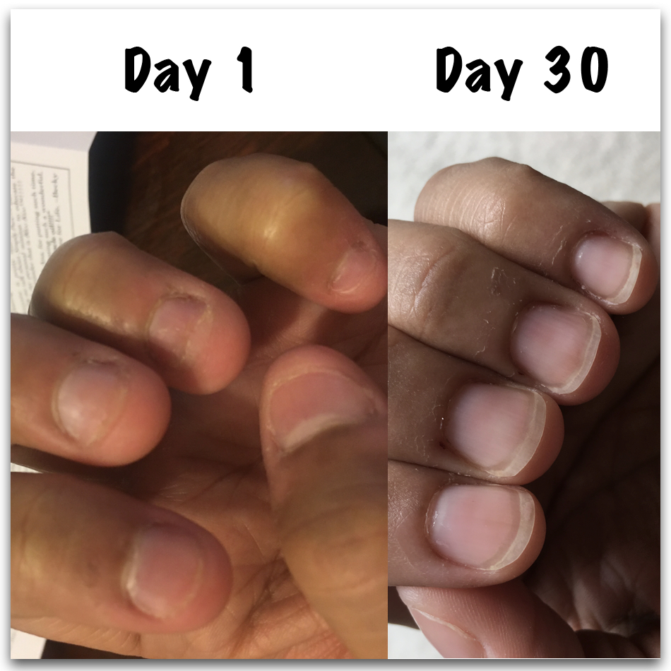 How to stop biting nails - Angela's nail oil results How to stop biting nails - Angela's nail oil results