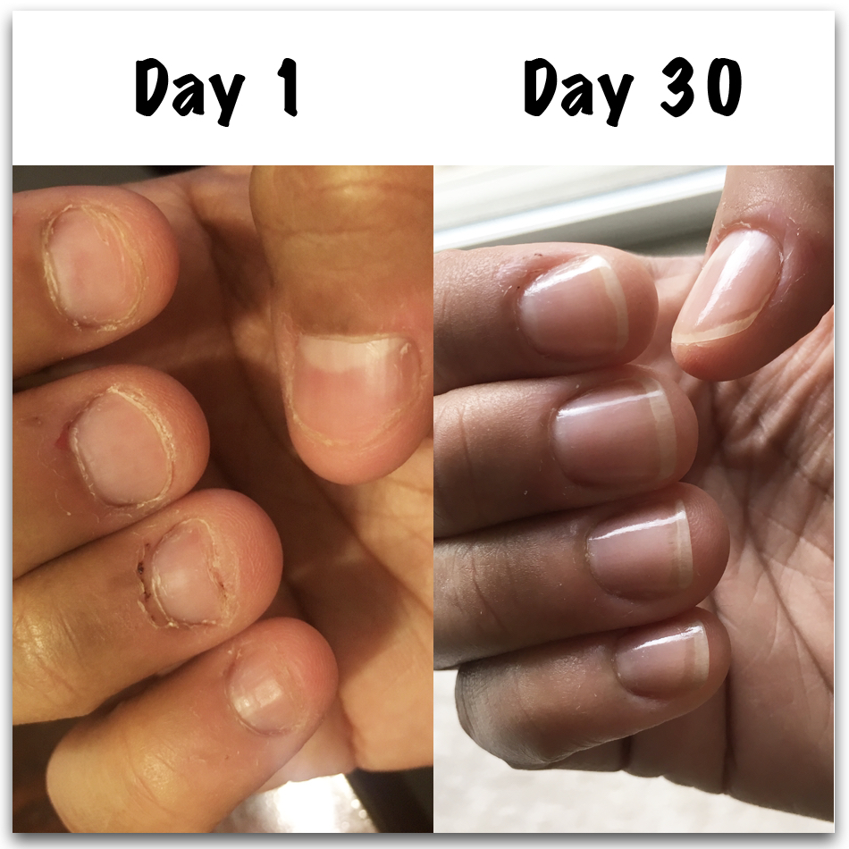 How to stop biting nails How to stop biting nails