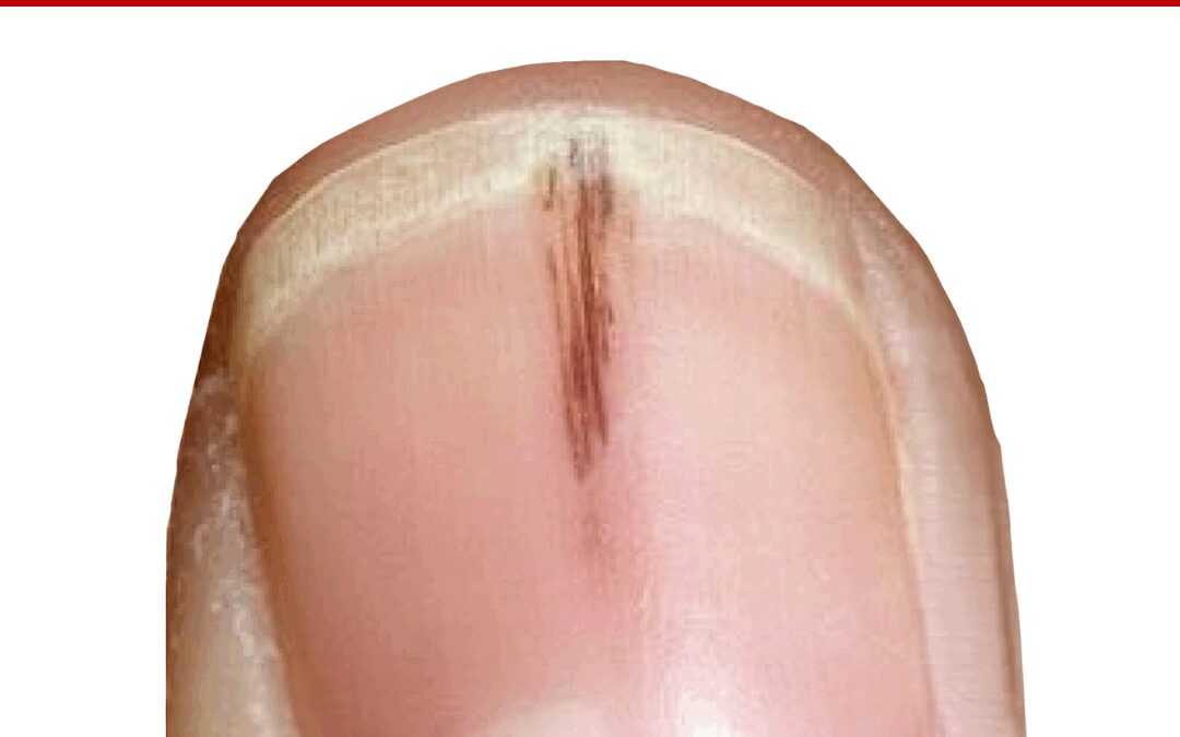 ASK ANA – Black Spots In Nails