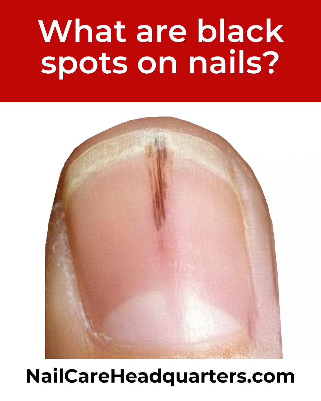 black-spots-in-nails-nailcarehq-800