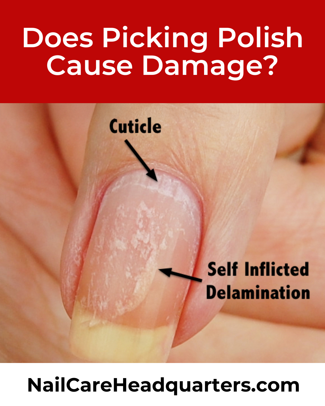picking-polish-damage-nailcarehq-1