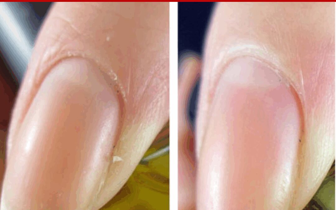 TREATMENT OF DRY SKIN – Pure Nail Oil™ Challenger Kira’s Results