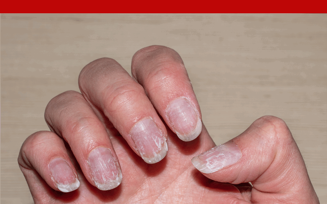 ASK DOUG: Peeling Nails – Is Polish Causing It?